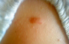 私密长了脓包,私密部位脓包成因及应对策略揭秘